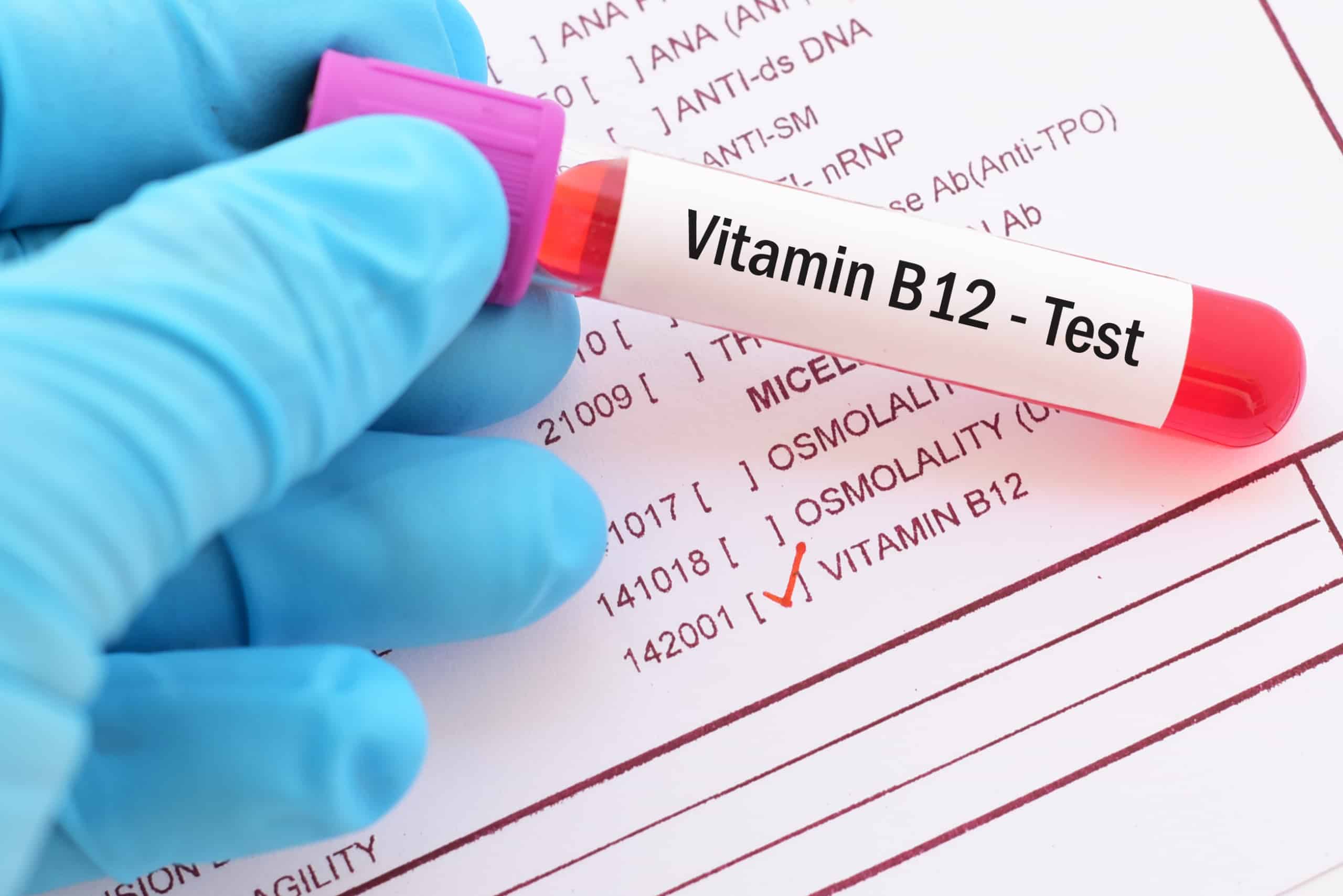 injectable b12 blood levels Vitamin Test: Price, Preparation, Procedure & Results Vitamin B12 Test Made Easy