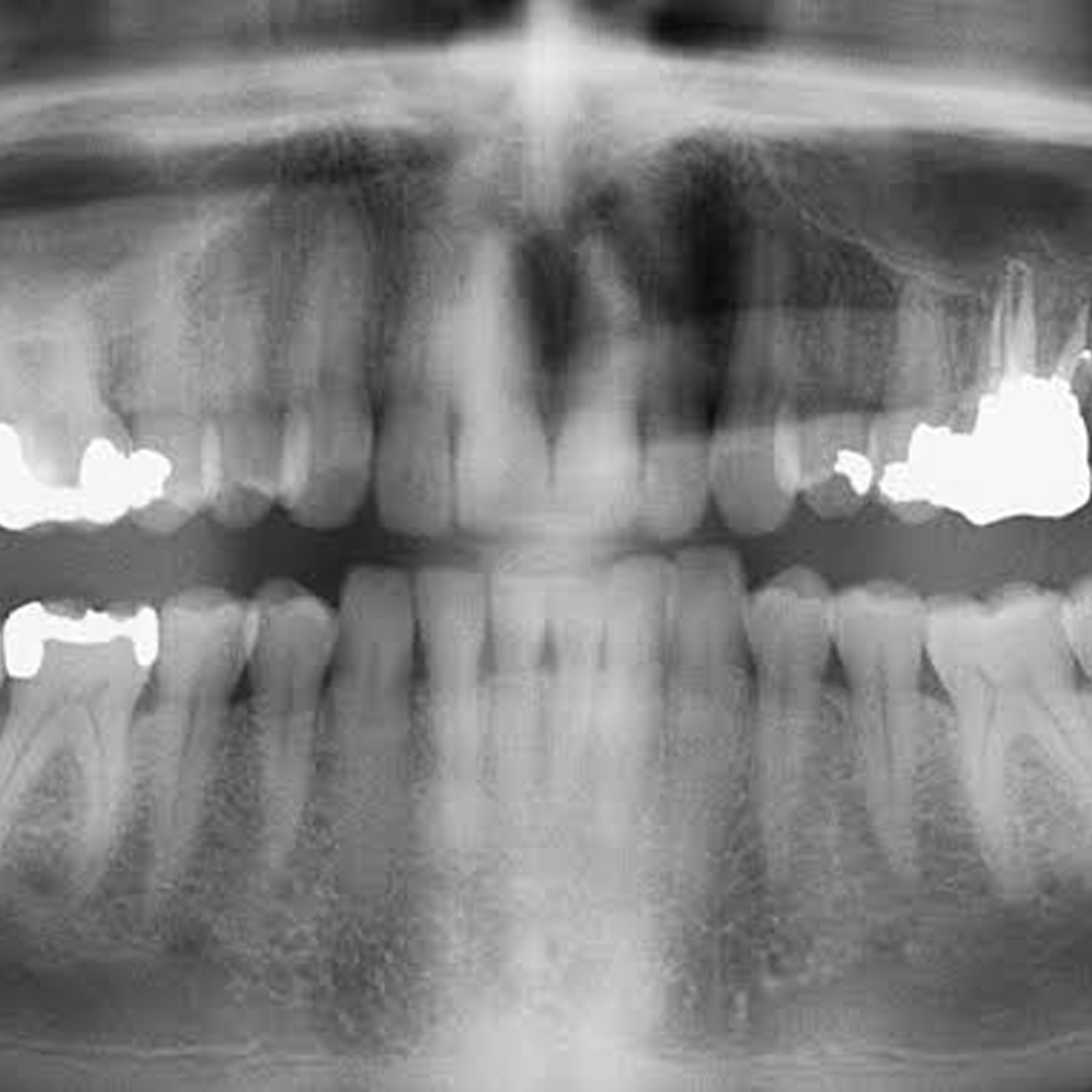 Dental OPG (ORTHOPANTOMAGRAM)