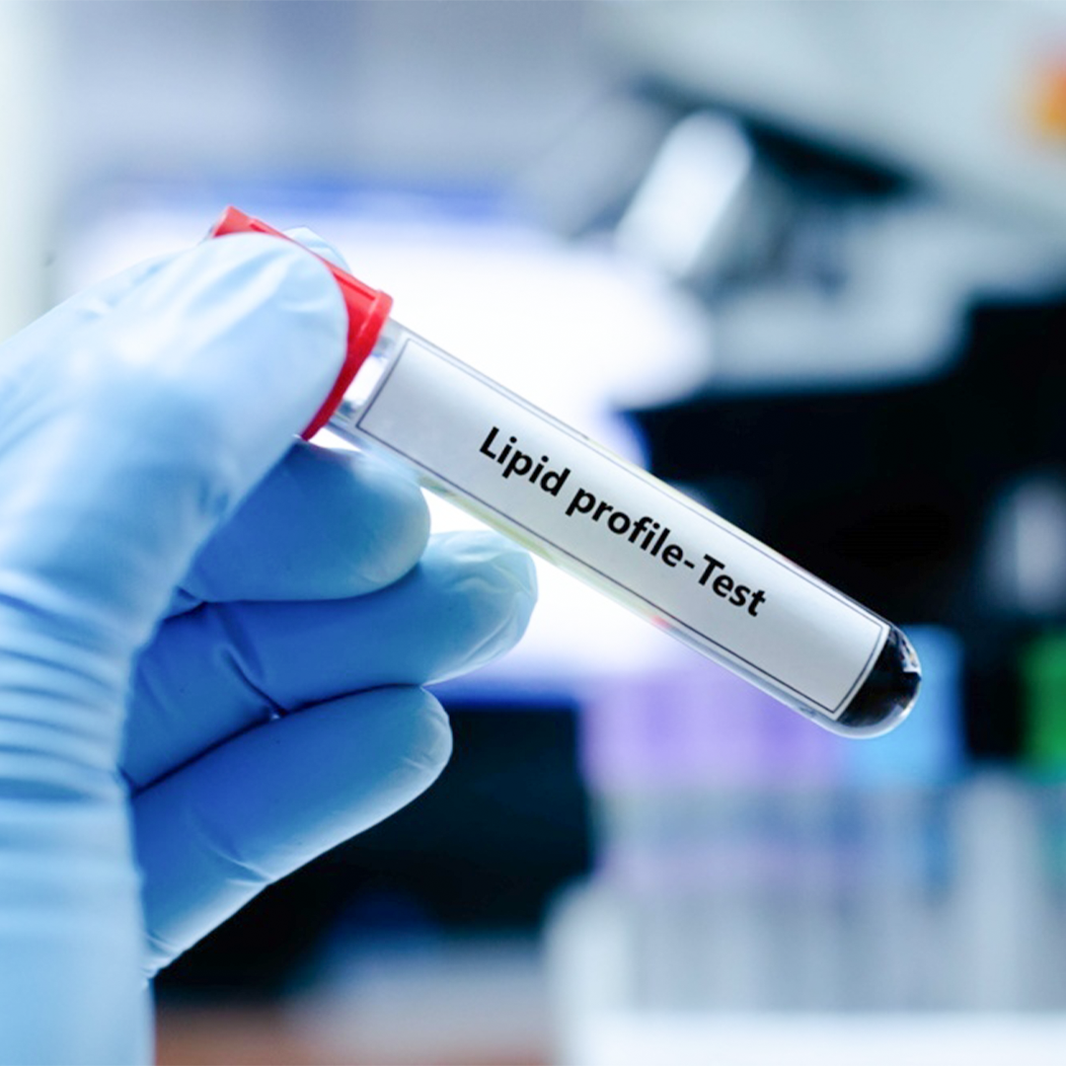 Labed Profile Lab Test Dr Essa Laboratory and Diagnostic Center – EssaLaboratory