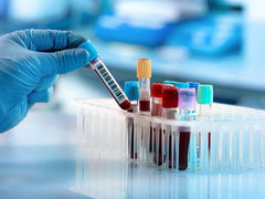 CSF Protein D/R