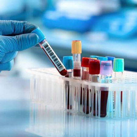 Erythrocyte Sedimentation rate (CBC ESR) – Blood Test