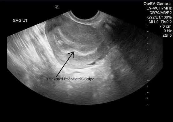 U/S breasts (LT)