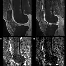 MRI Knee Joint with Contrast