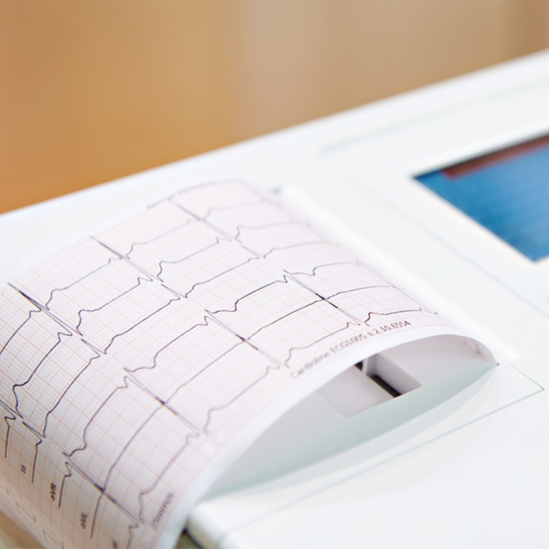 ECG