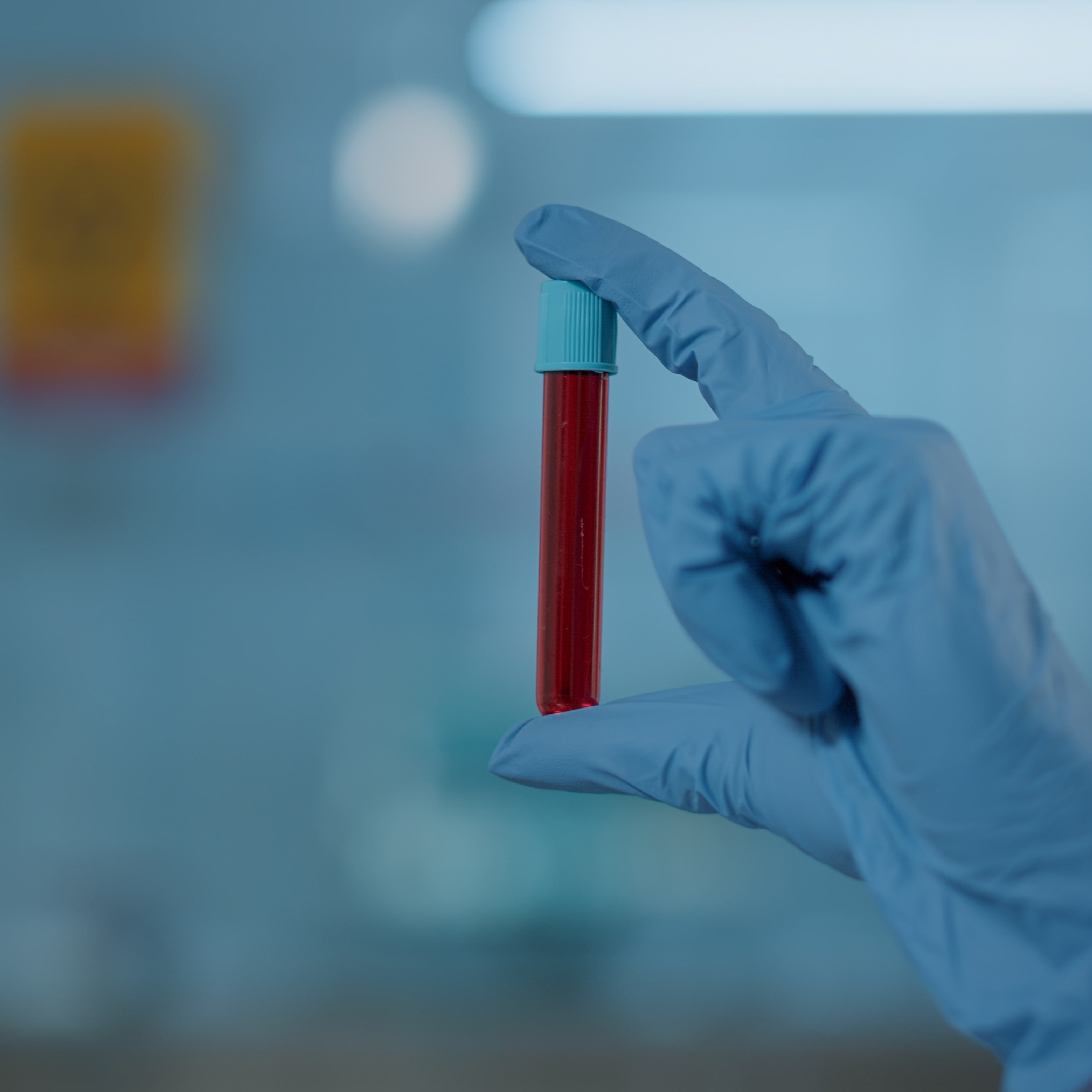 Glucose Challenge Test (GCT)