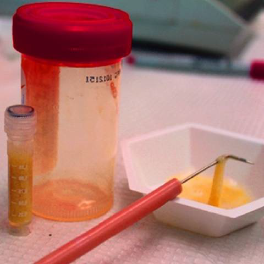 Sputum AFB (ZNCF) - Random