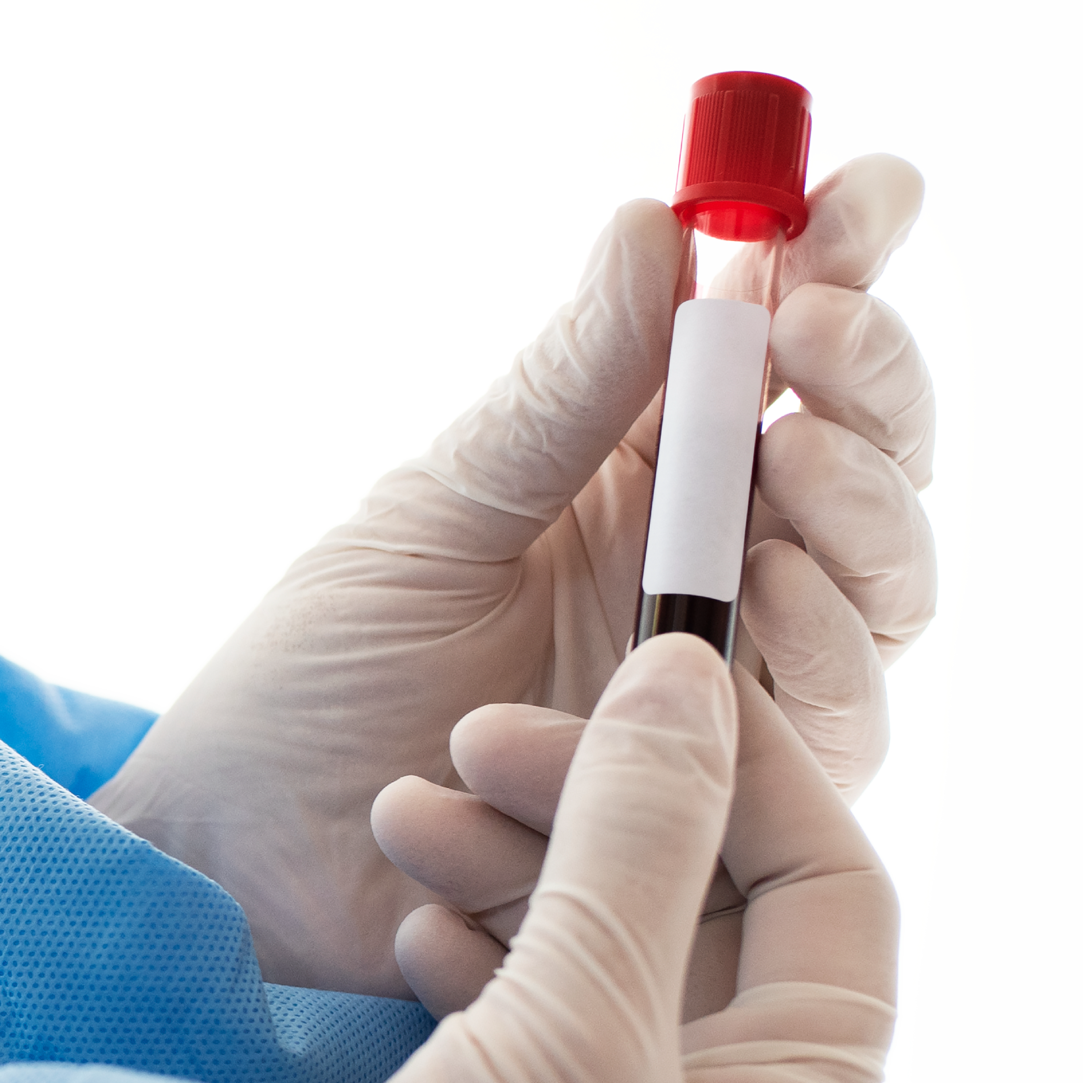 Total Leucocytes Counts (TLC)