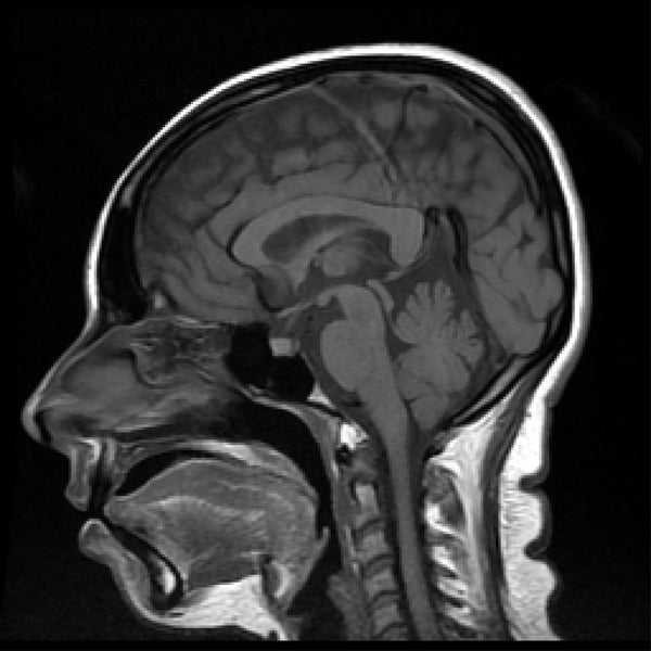 MRI Brain (Full Study) Plain