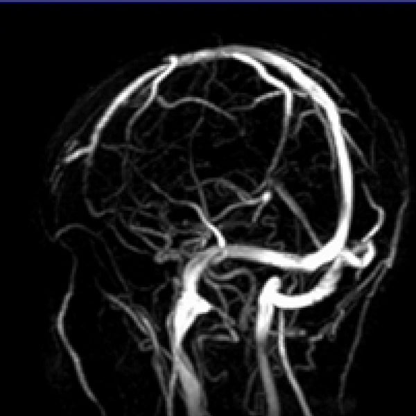 MRI Brain MRA / MRV with Contrast EssaLaboratory