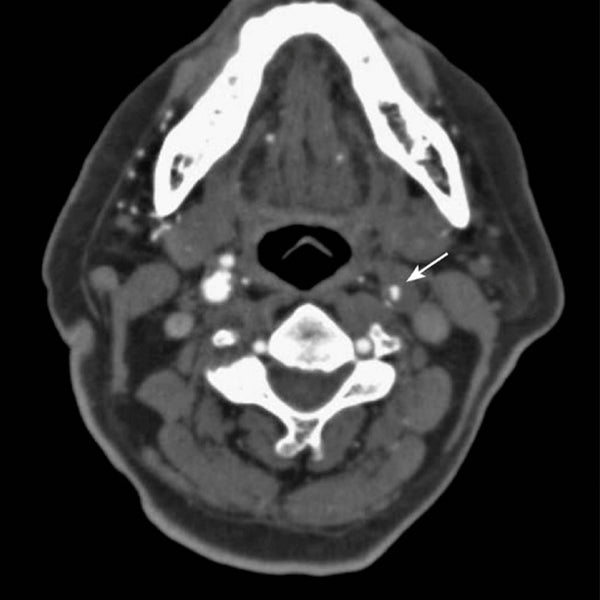 MRI Carotid Plain