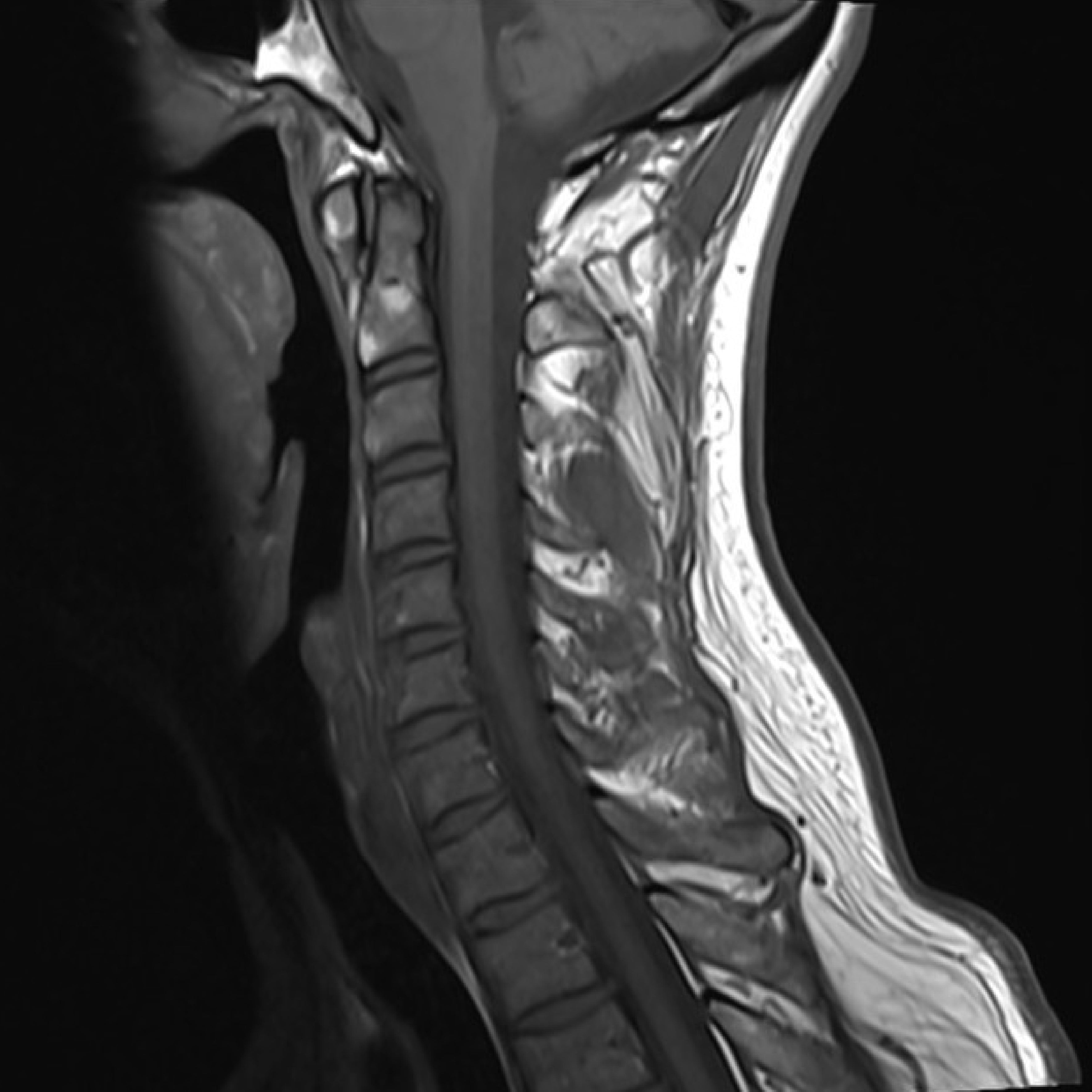 MRI Cervical Spine Plain