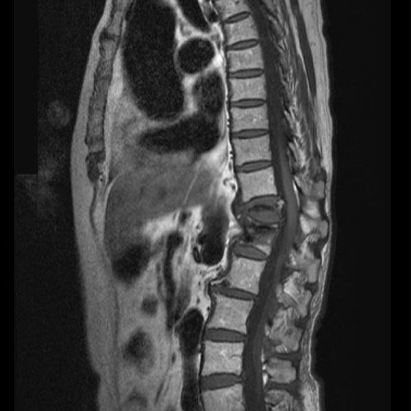 MRI Cervical Spine with Contrast