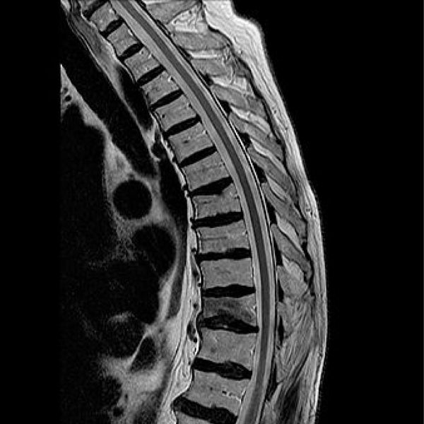 MRI Dorsal/Thorasic Spine Plain