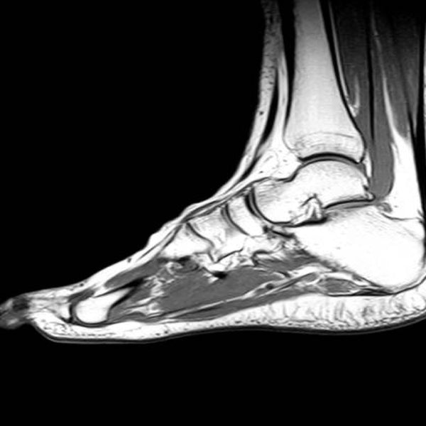 MRI Foot Plain