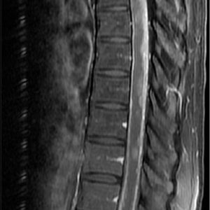 MRI Dorsal/Thorasic Spine with Contrast