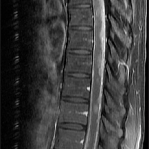 MRI Dorsal/Thorasic Spine with Contrast