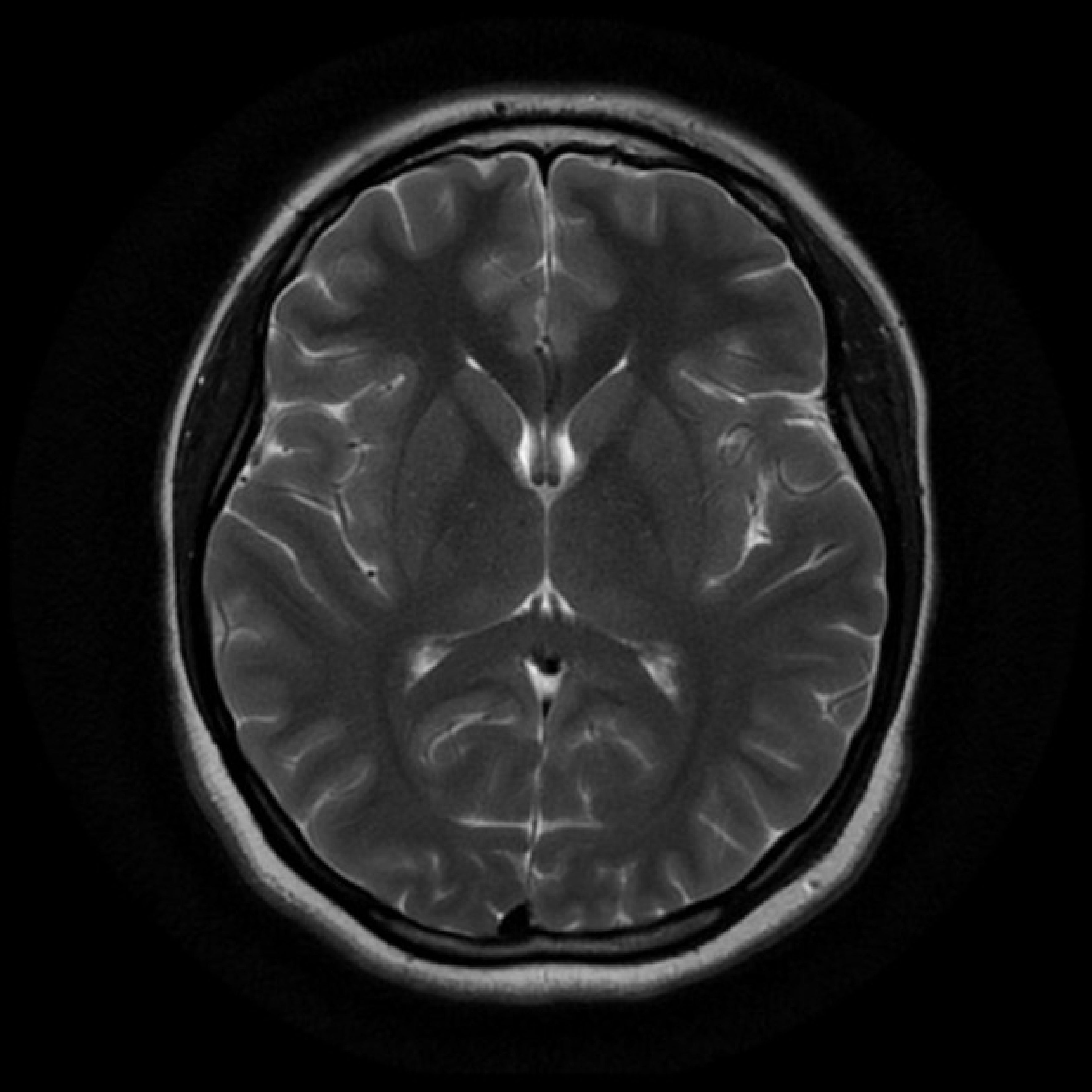 MRI Brain (IAC Plain)