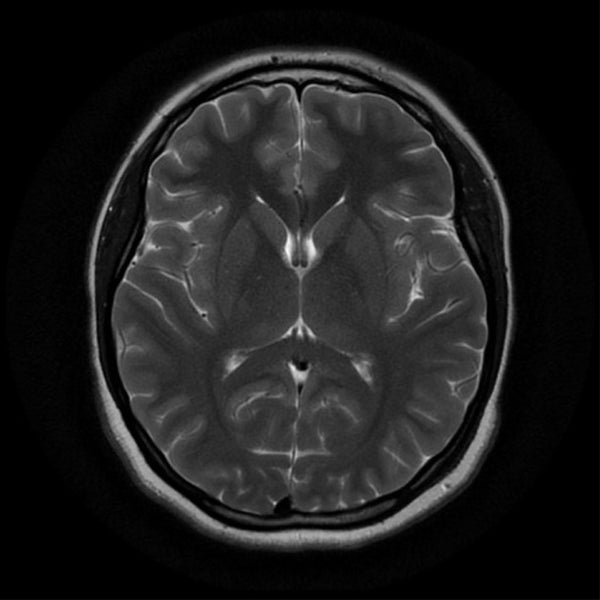MRI Brain & Orbit Plain