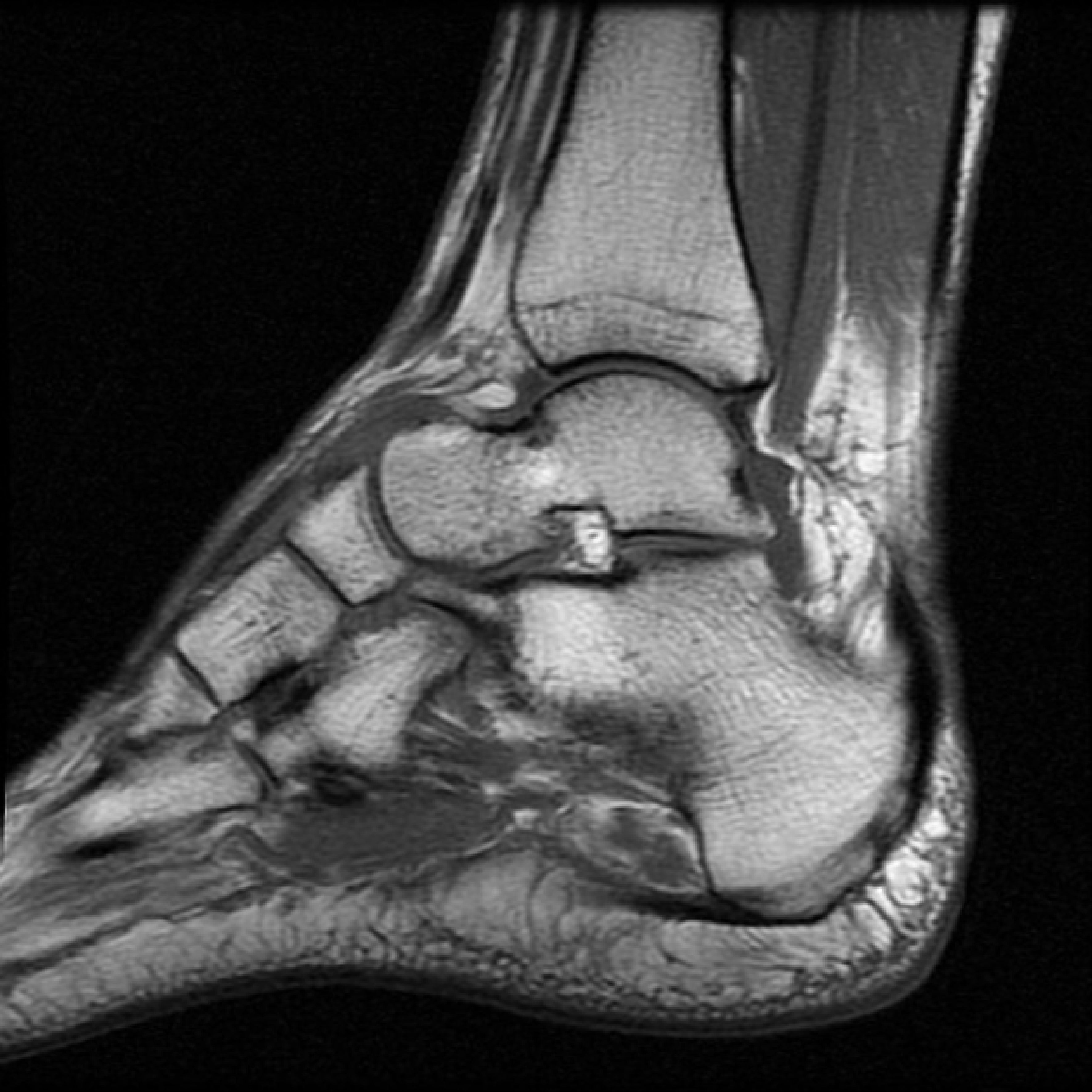 MRI Ankle Joint Plain