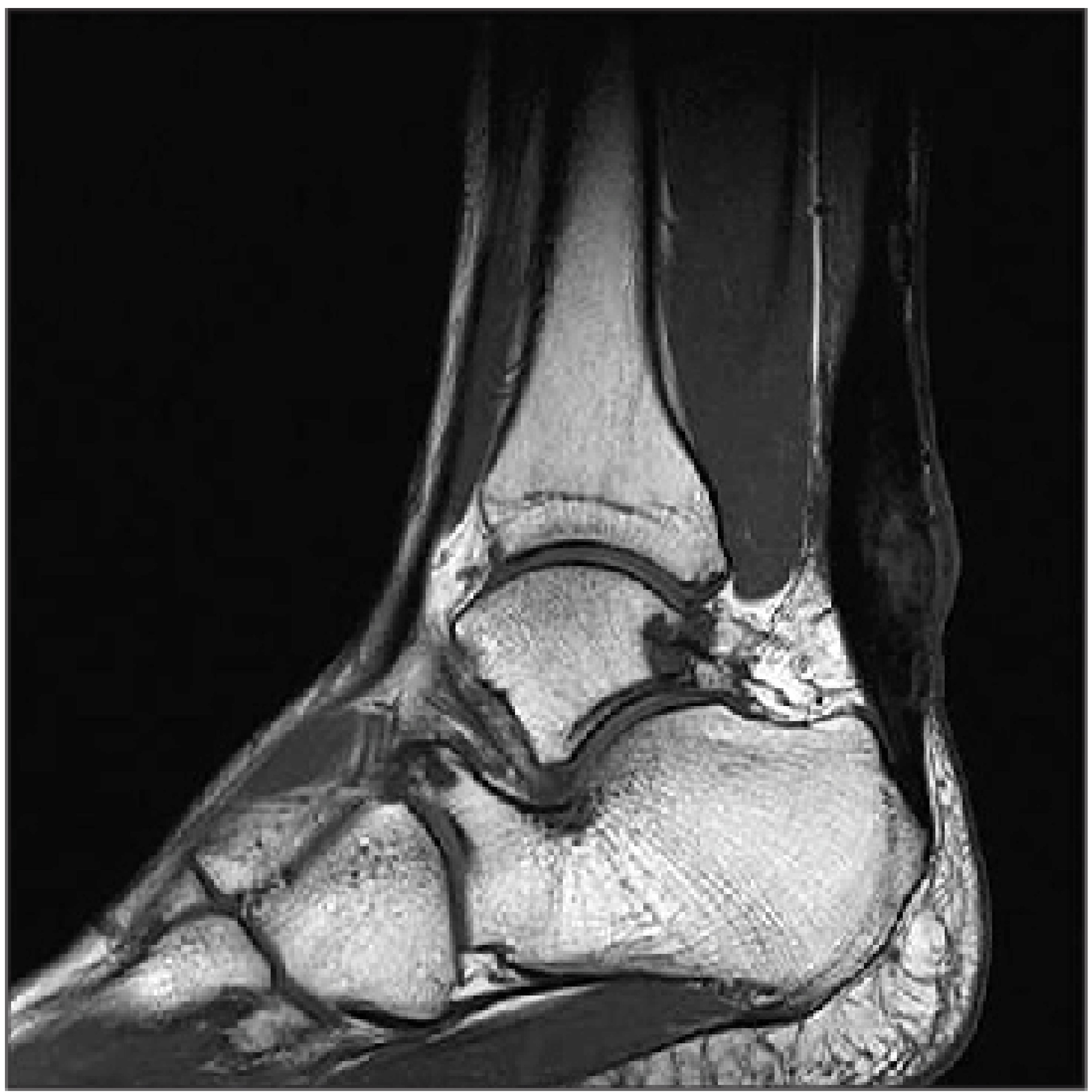 MRI Ankle Joint with Contrast