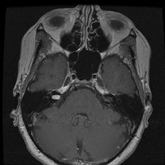 MRI Brain & IAC with Contrast EssaLaboratory